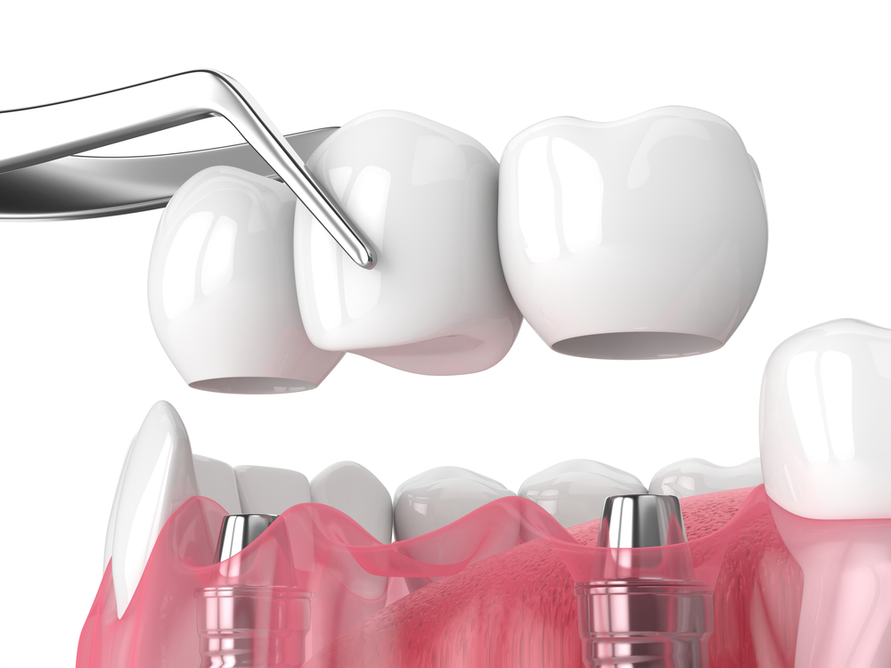 dental crown and bridge